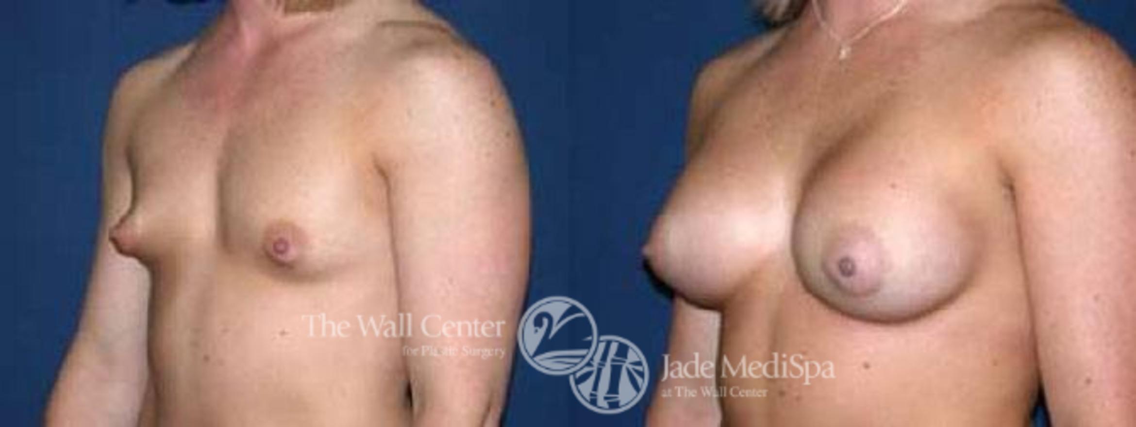 Before & After Breast Augmentation Case 38 View #2 View in Shreveport, LA