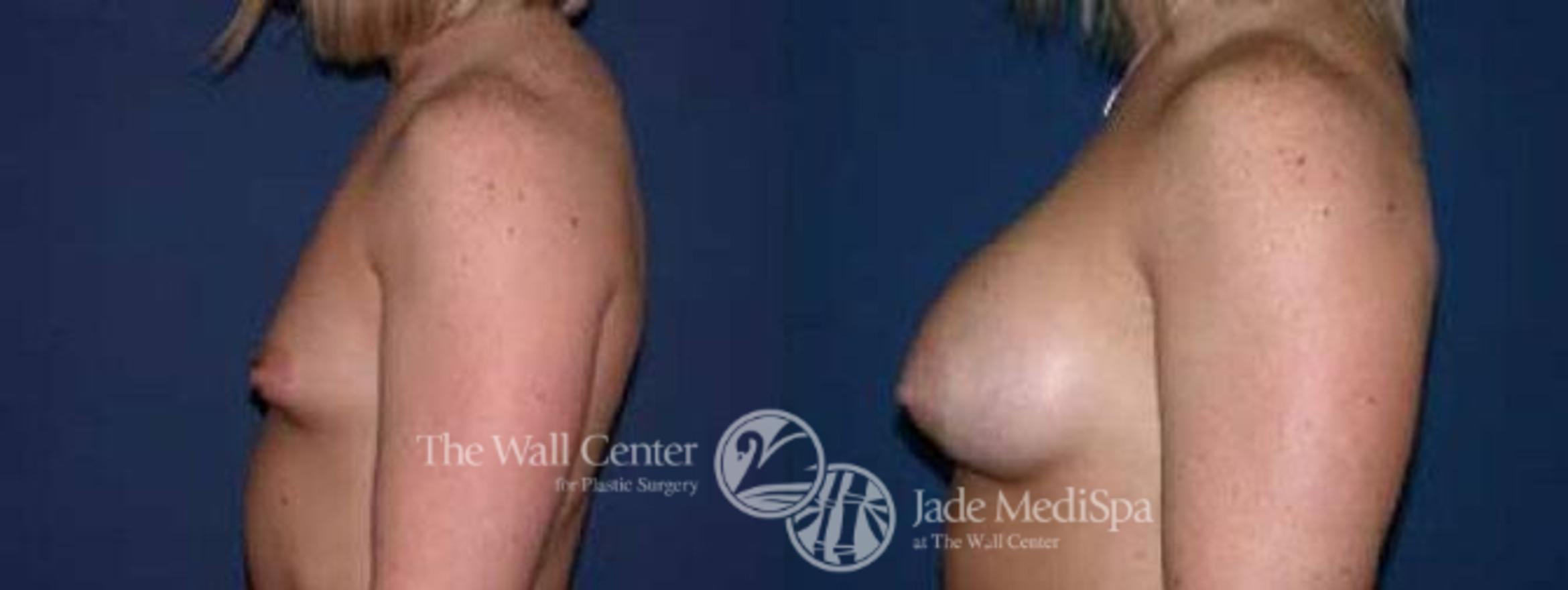 Before & After Breast Augmentation Case 38 View #3 View in Shreveport, LA