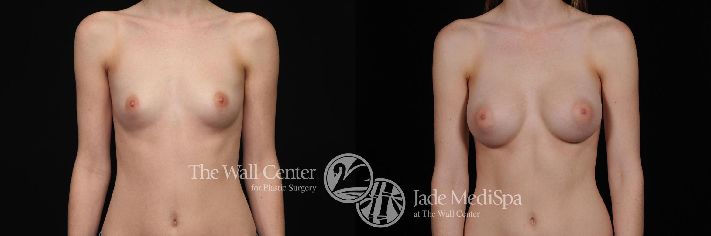 Before & After Breast Augmentation Case 403 View #1 View in Shreveport, LA