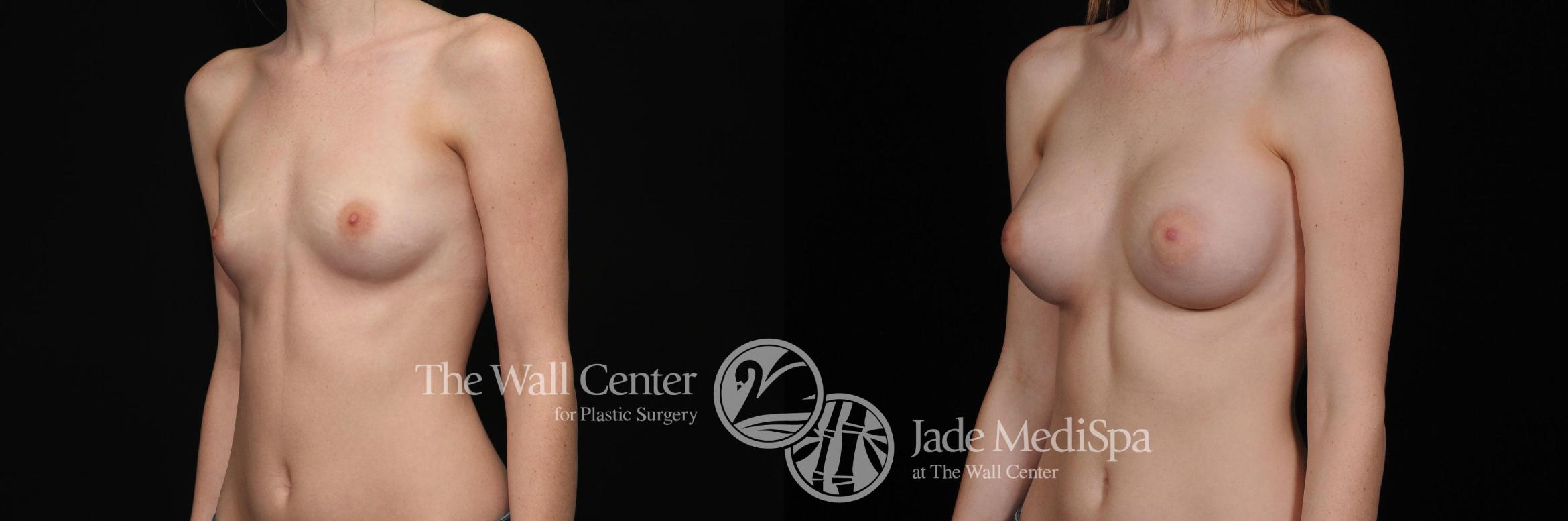 Before & After Breast Augmentation Case 403 View #2 View in Shreveport, LA