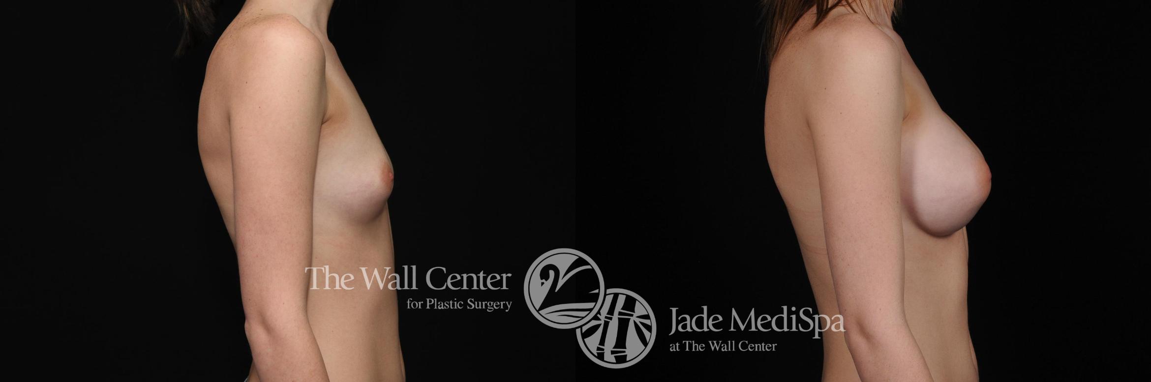 Before & After Breast Augmentation Case 403 View #3 View in Shreveport, LA