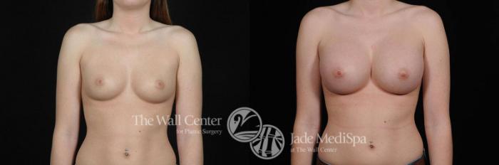 Before & After Breast Augmentation Case 433 View #1 View in Shreveport, LA