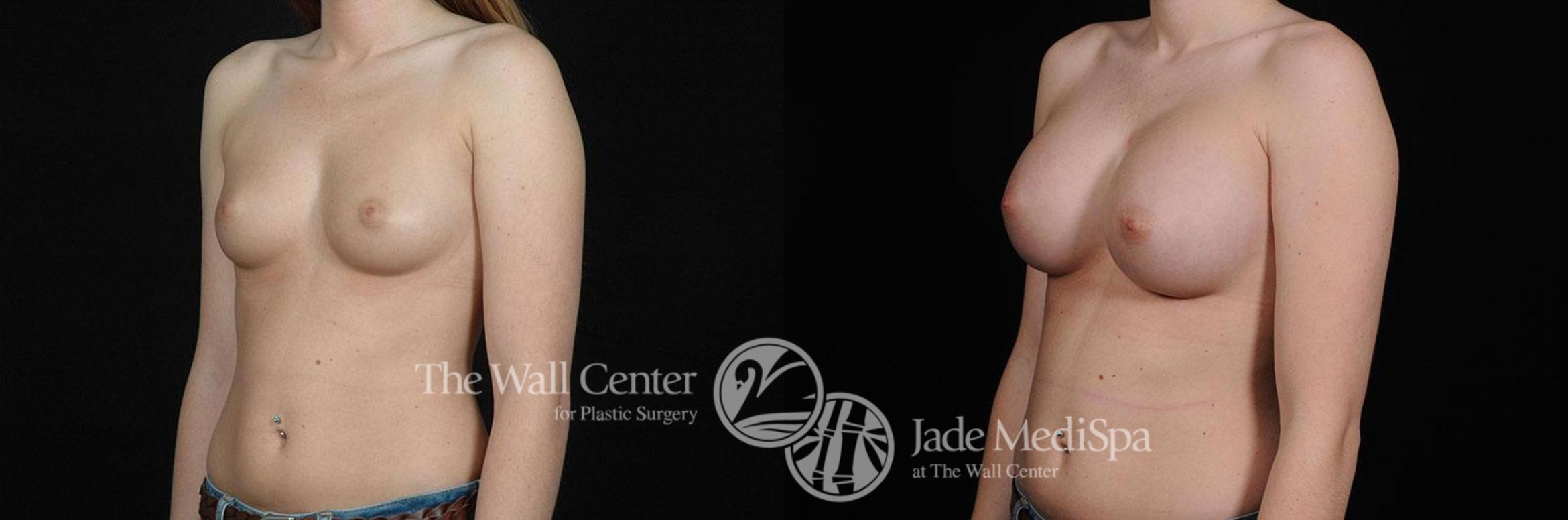 Before & After Breast Augmentation Case 433 View #2 View in Shreveport, LA