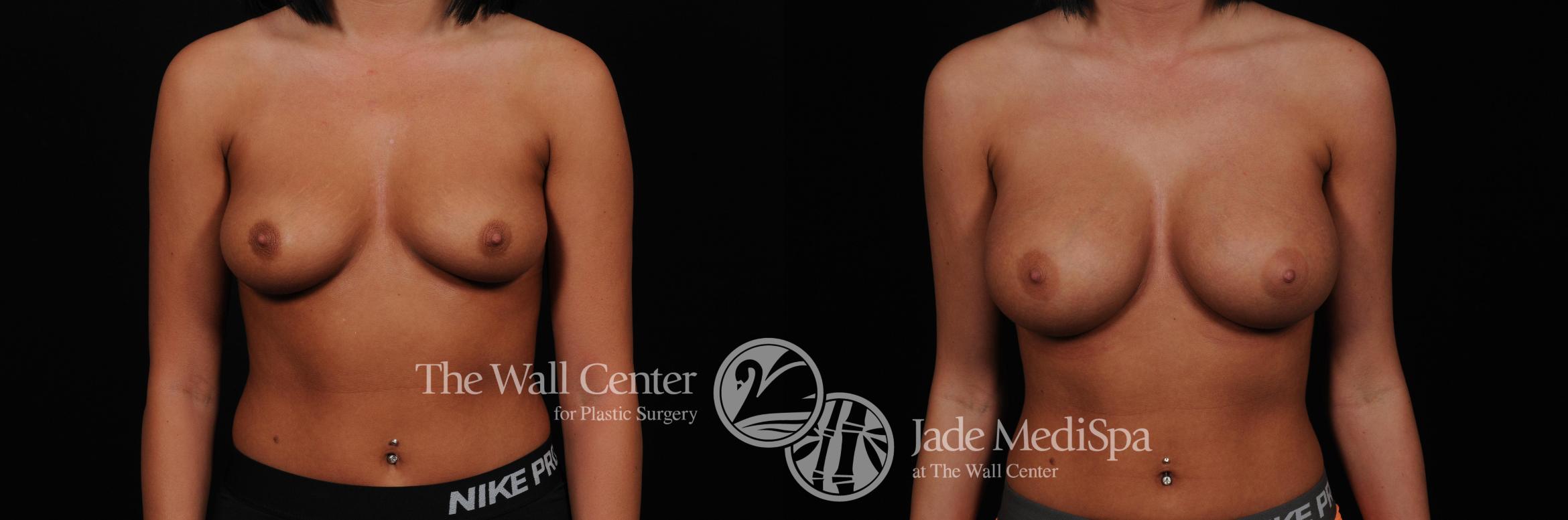 Before & After Breast Augmentation Case 437 View #1 View in Shreveport, LA