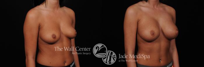 Before & After Breast Augmentation Case 437 View #2 View in Shreveport, LA
