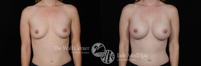 Before & After Breast Augmentation Case 449 View #1 View in Shreveport, LA