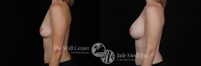 Before & After Breast Augmentation Case 449 View #3 View in Shreveport, LA