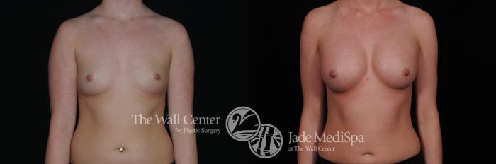 Before & After Breast Augmentation Case 451 View #1 View in Shreveport, LA