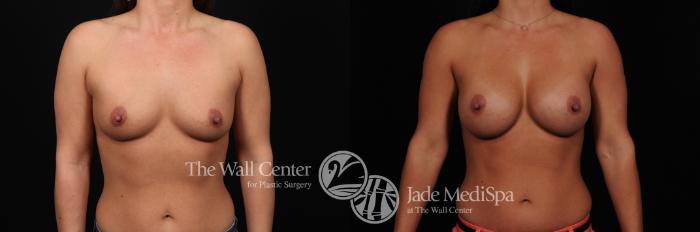 Before & After Breast Augmentation Case 457 View #1 View in Shreveport, LA