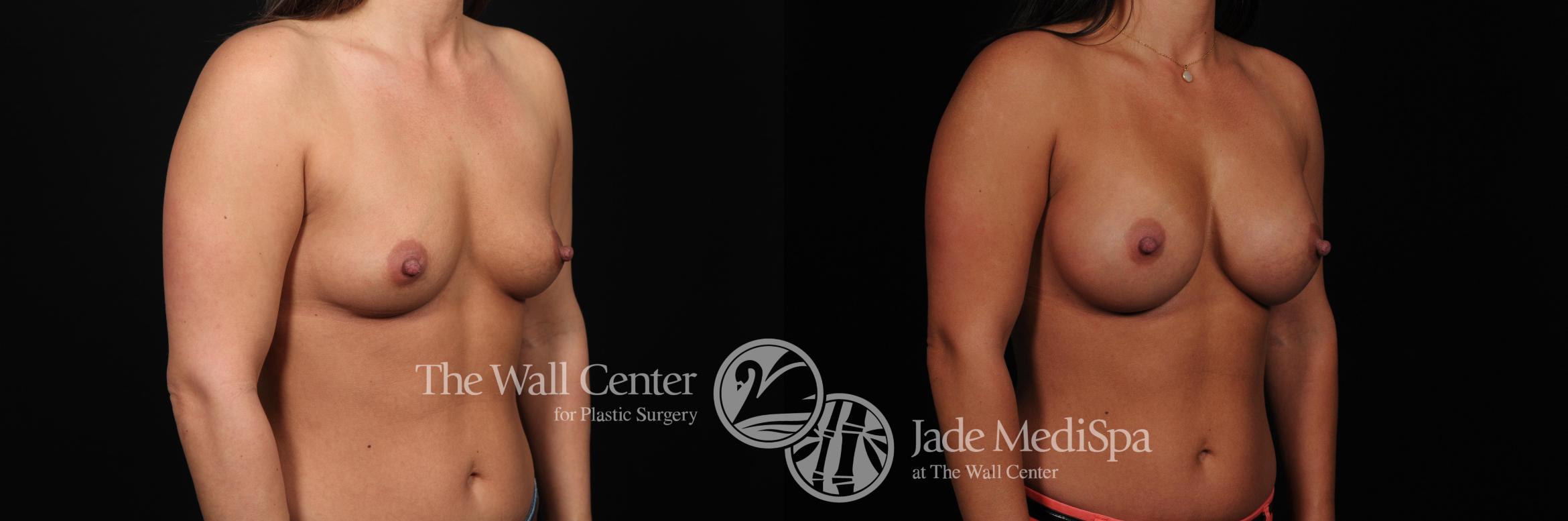Before & After Breast Augmentation Case 457 View #2 View in Shreveport, LA