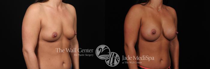 Before & After Breast Augmentation Case 457 View #2 View in Shreveport, LA