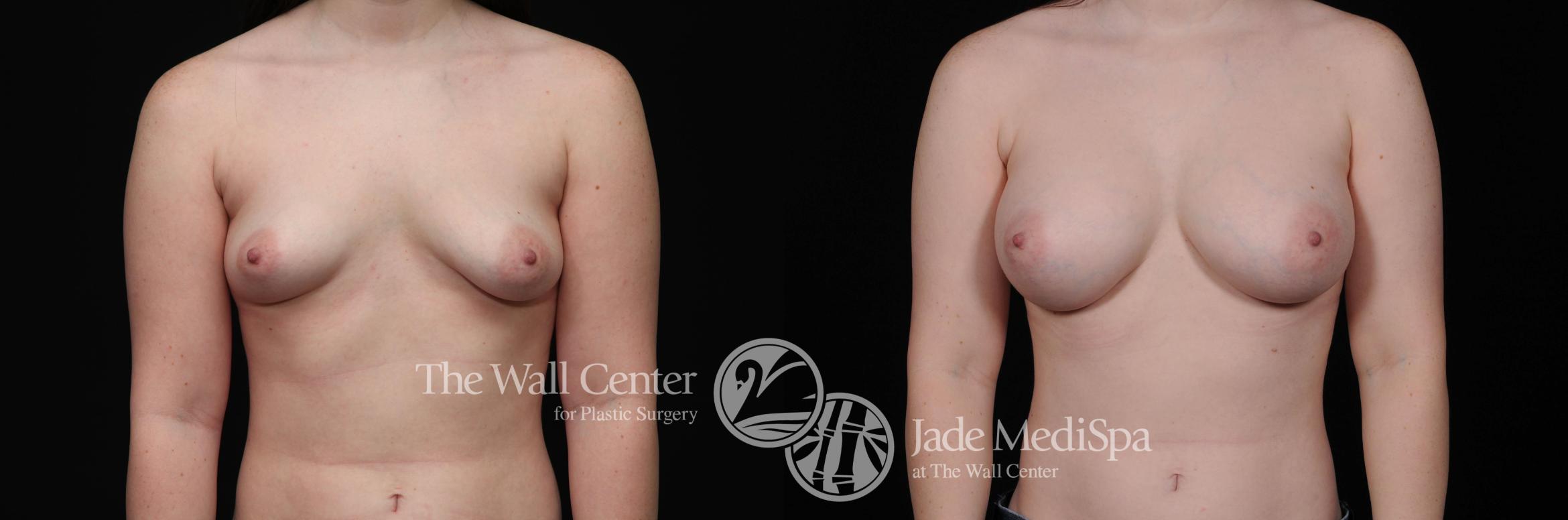 Breast Augmentation Case 460 Before & After View #1 | Shreveport, LA | The Wall Center