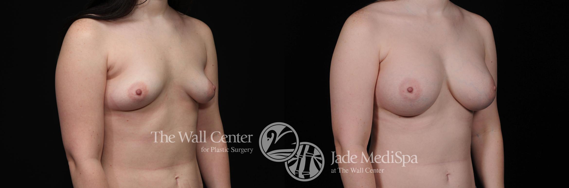 Before & After Breast Augmentation Case 460 View #2 View in Shreveport, LA