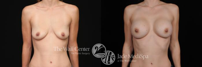 Before & After Breast Augmentation Case 466 View #1 View in Shreveport, LA