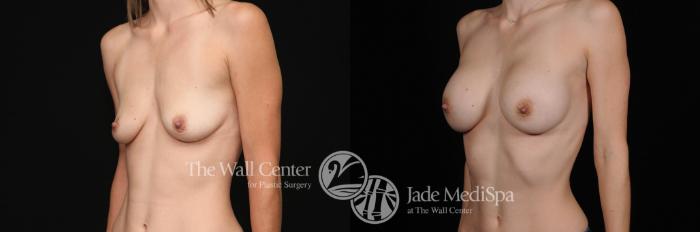 Before & After Breast Augmentation Case 466 View #2 View in Shreveport, LA