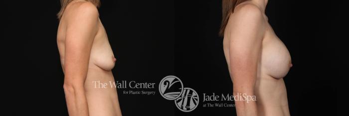 Before & After Breast Augmentation Case 466 View #3 View in Shreveport, LA