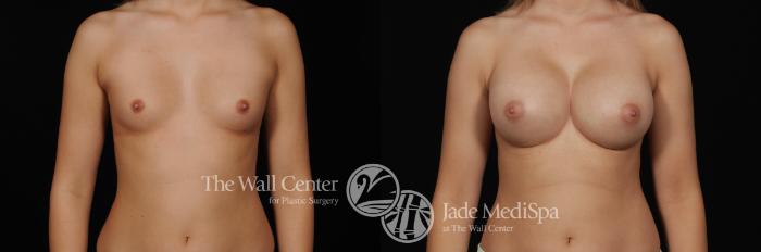 Before & After Breast Augmentation Case 469 View #1 View in Shreveport, LA