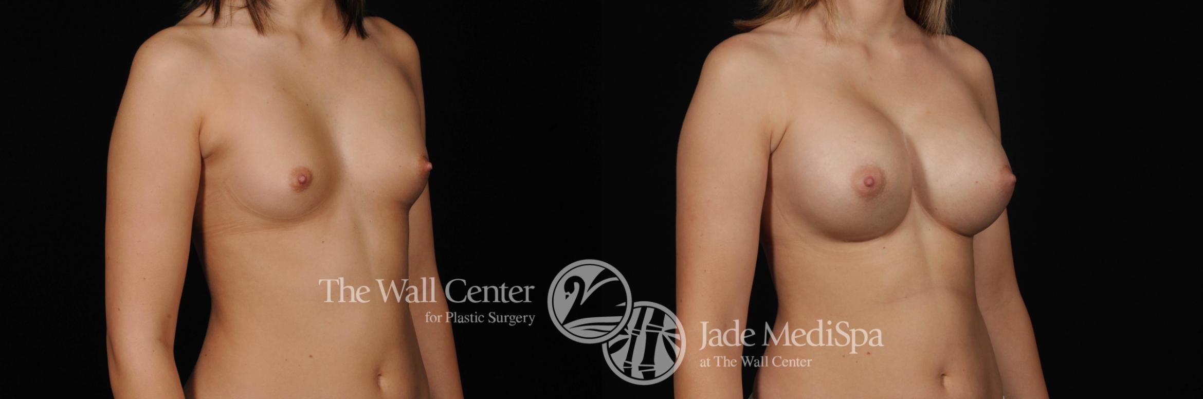 Before & After Breast Augmentation Case 469 View #2 View in Shreveport, LA