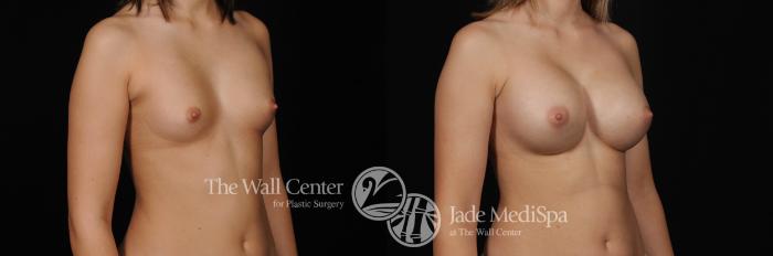 Before & After Breast Augmentation Case 469 View #2 View in Shreveport, LA