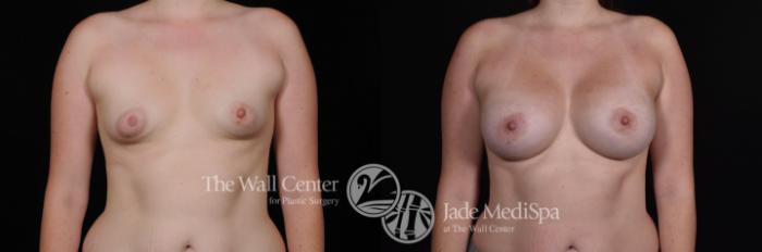 Before & After Breast Augmentation Case 473 View #1 View in Shreveport, LA