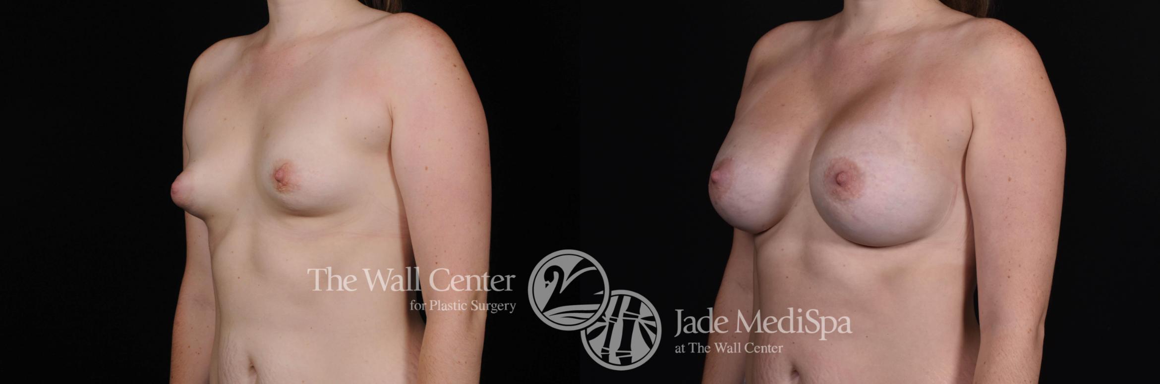 Before & After Breast Augmentation Case 473 View #2 View in Shreveport, LA