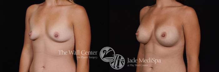 Before & After Breast Augmentation Case 505 View #2 View in Shreveport, LA