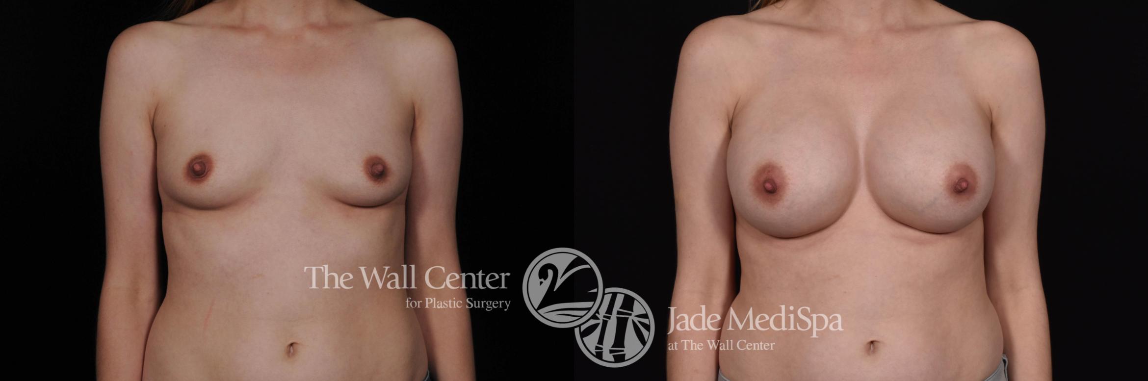 Before & After Breast Augmentation Case 506 View #1 View in Shreveport, LA