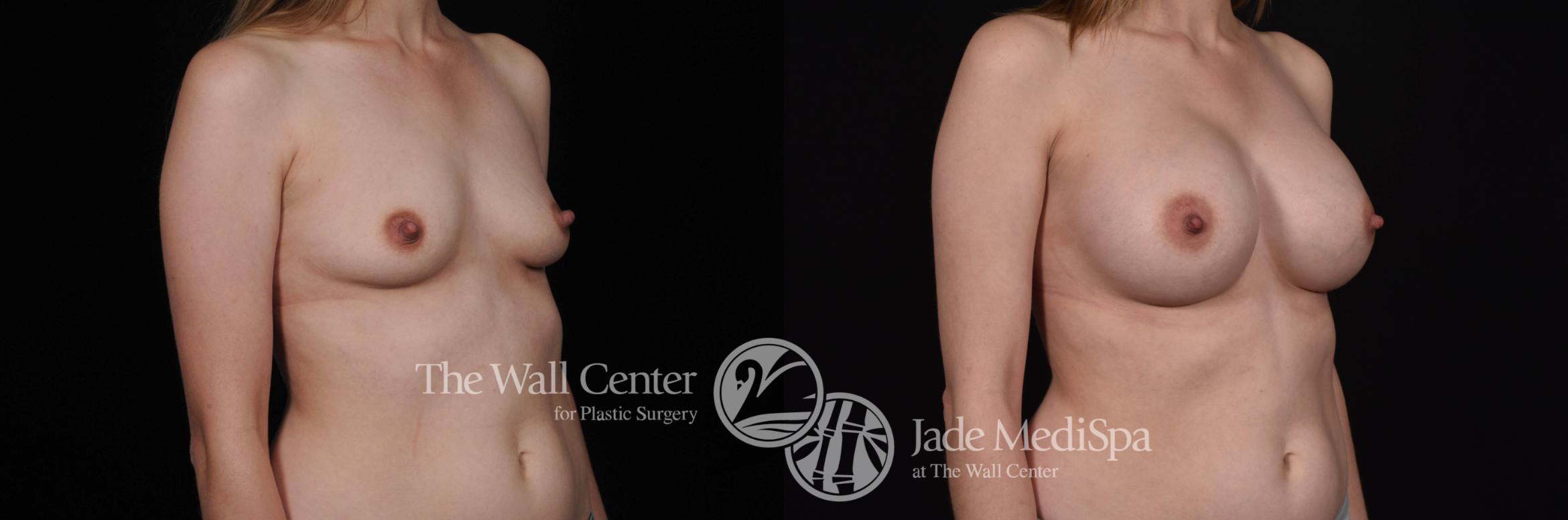 Before & After Breast Augmentation Case 506 View #2 View in Shreveport, LA