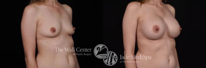 Before & After Breast Augmentation Case 506 View #2 View in Shreveport, LA