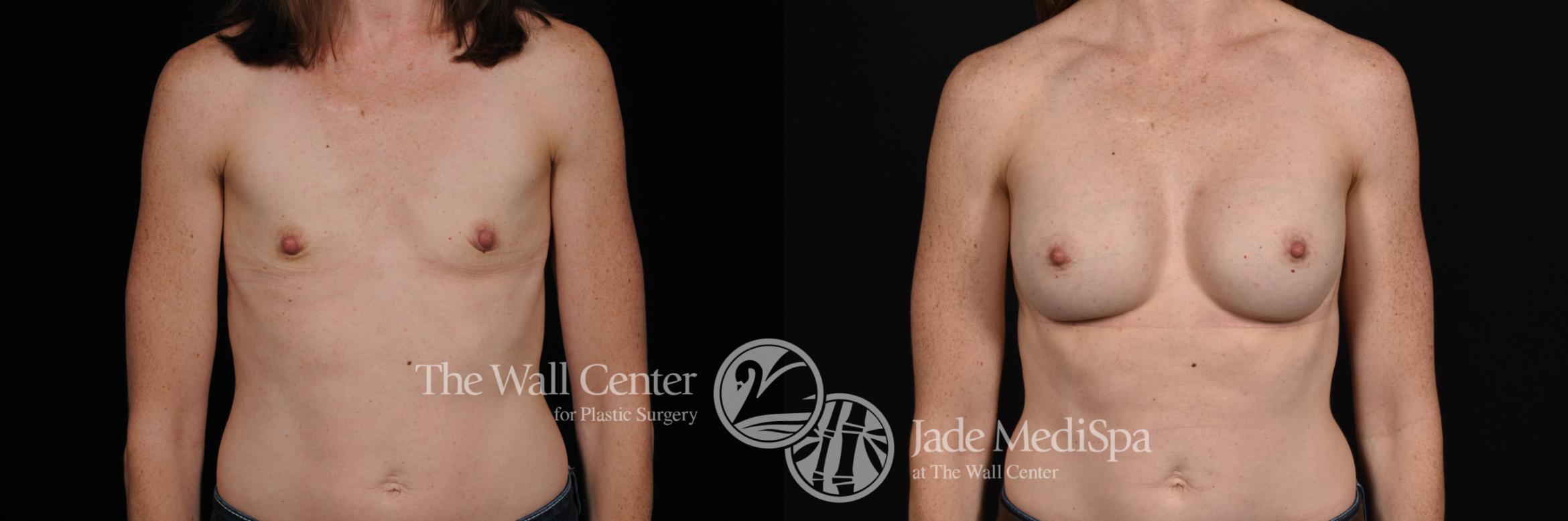 Before & After Breast Augmentation Case 543 View #1 View in Shreveport, LA