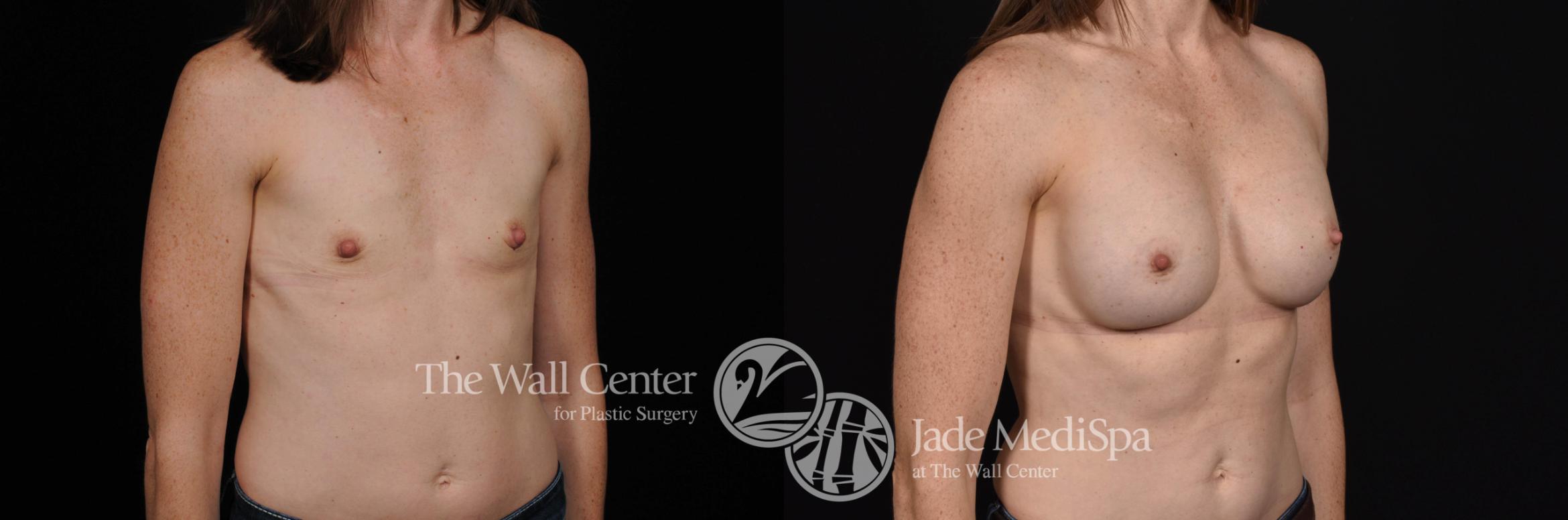 Before & After Breast Augmentation Case 543 View #2 View in Shreveport, LA