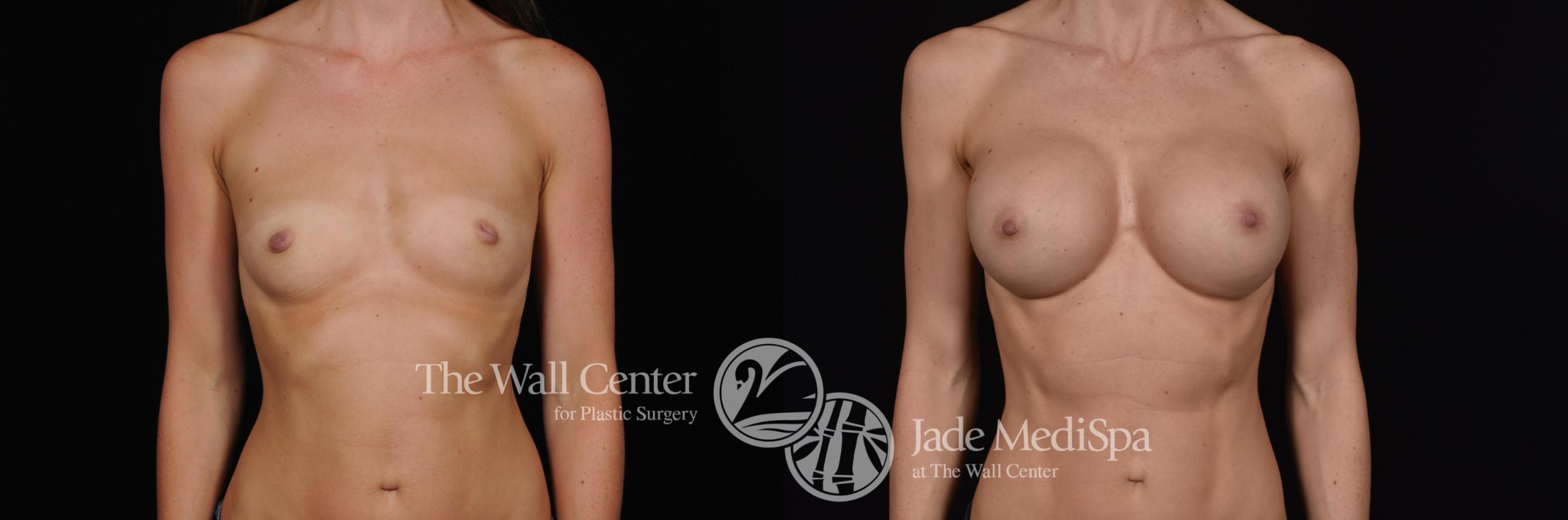 Before & After Breast Augmentation Case 546 View #1 View in Shreveport, LA