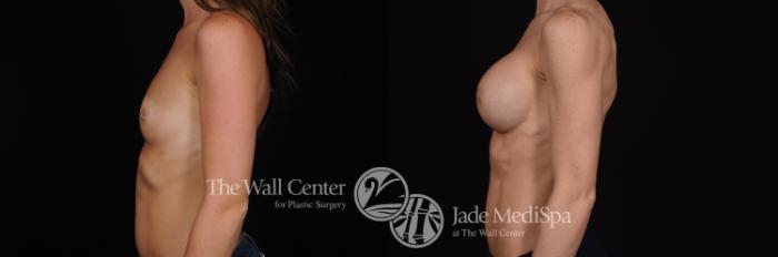 Before & After Breast Augmentation Case 546 View #3 View in Shreveport, LA