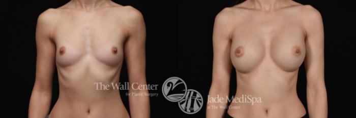 Before & After Breast Augmentation Case 559 View #1 View in Shreveport, LA