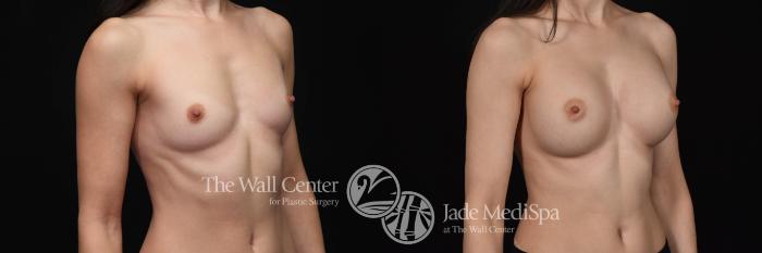 Before & After Breast Augmentation Case 559 View #2 View in Shreveport, LA
