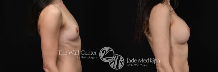 Before & After Breast Augmentation Case 559 View #3 View in Shreveport, LA