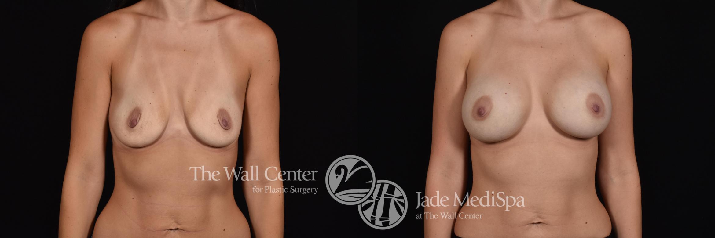 Before & After Breast Augmentation Case 564 View #1 View in Shreveport, LA