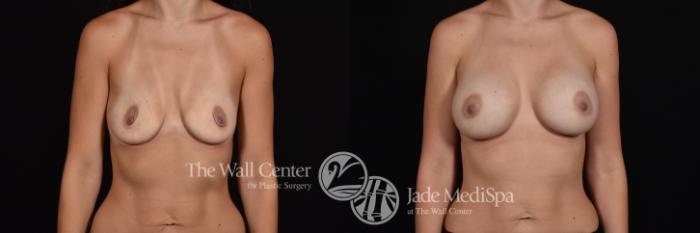 Before & After Breast Augmentation Case 564 View #1 View in Shreveport, LA