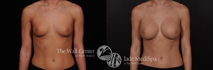Before & After Breast Augmentation Case 565 View #1 View in Shreveport, LA