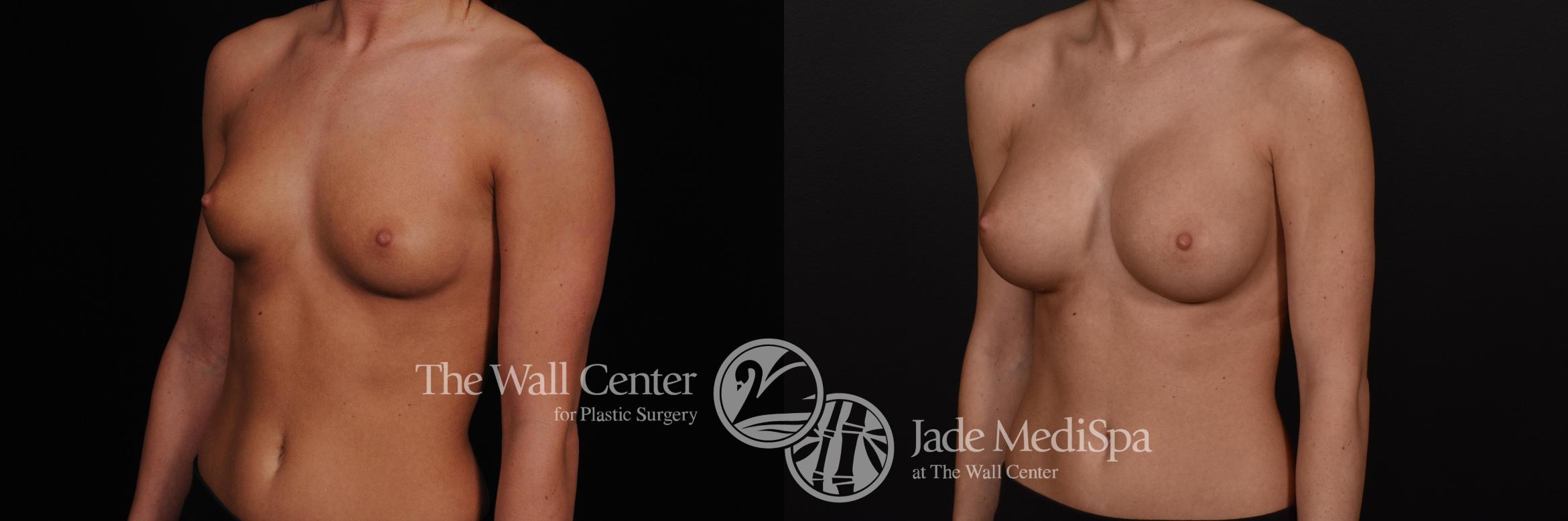 Before & After Breast Augmentation Case 565 View #2 View in Shreveport, LA