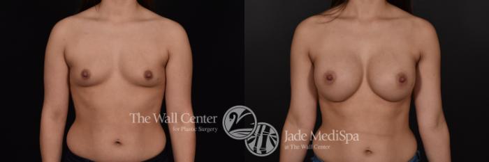 Before & After Breast Augmentation Case 569 View #1 View in Shreveport, LA