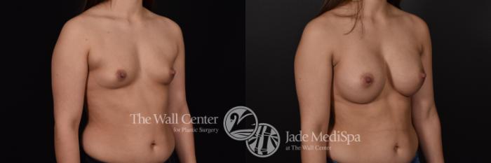 Before & After Breast Augmentation Case 569 View #2 View in Shreveport, LA