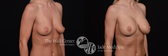 Before & After Breast Augmentation Case 580 View #2 View in Shreveport, LA