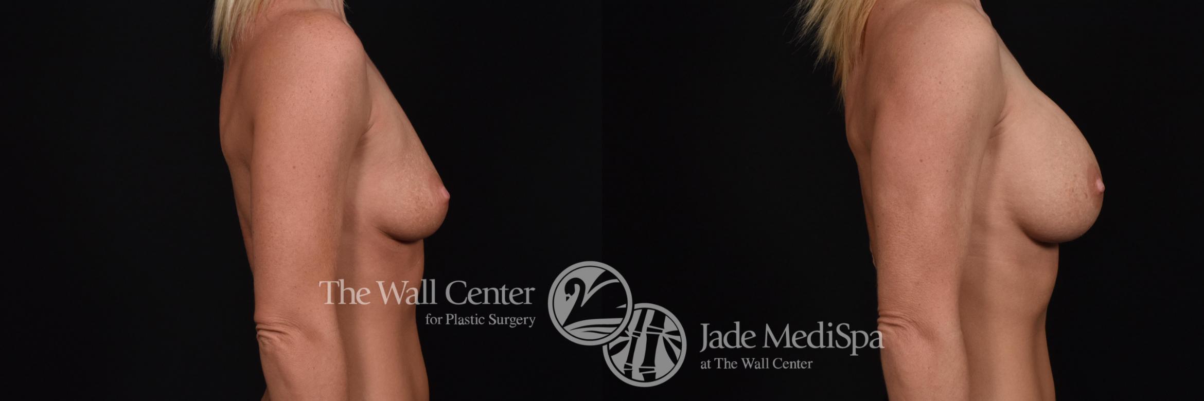 Before & After Breast Augmentation Case 580 View #3 View in Shreveport, LA