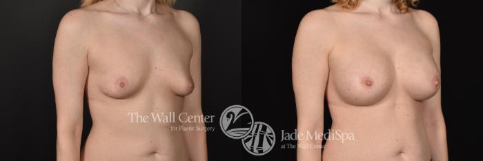 Before & After Breast Augmentation Case 581 View #2 View in Shreveport, LA