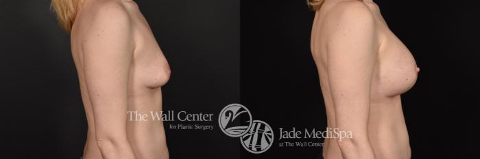 Before & After Breast Augmentation Case 581 View #3 View in Shreveport, LA