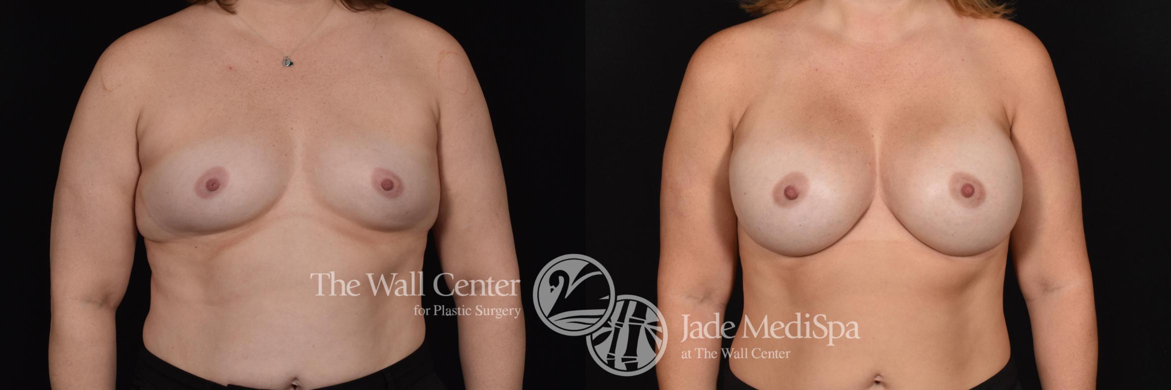 Before & After Breast Augmentation Case 583 View #1 View in Shreveport, LA
