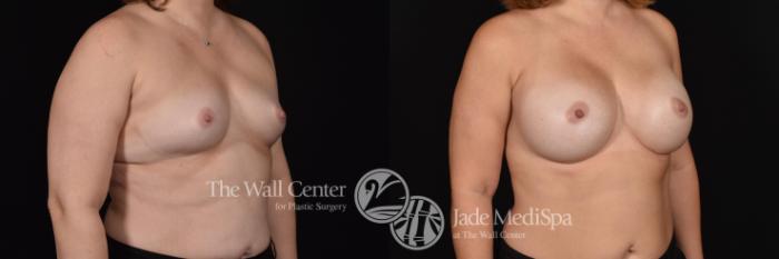 Before & After Breast Augmentation Case 583 View #2 View in Shreveport, LA
