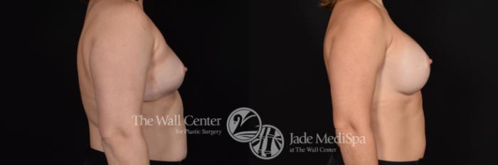 Before & After Breast Augmentation Case 583 View #3 View in Shreveport, LA