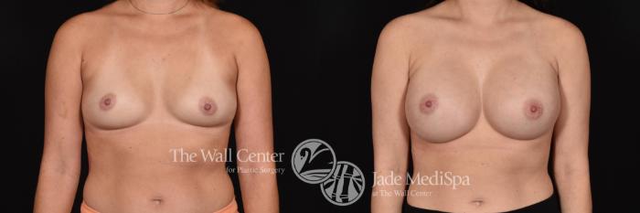 Before & After Breast Augmentation Case 585 View #1 View in Shreveport, LA